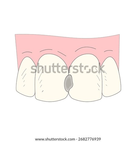 Front tooth decay. Dirty teeth. Oral health. Health theme. dental caries. Vector illustration