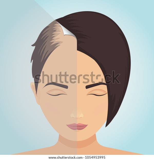 Front view\
of a balding woman before and after hair treatment. Divided image\
of the head. Two halves. Sticker revealing healthy scalp. Female\
alopecia. Isolated vector\
illustration.