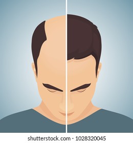 Front view portrait of a man with alopecia before and after hair treatment and transplantation. Divided image of the head. Two halves. Health care and beauty concept. Vector illustration.