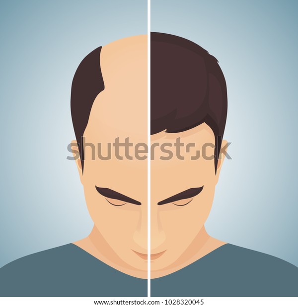 Front view portrait of a man with alopecia\
before and after hair treatment and transplantation. Divided image\
of the head. Two halves. Health care and beauty concept. Vector\
illustration.
