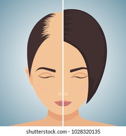 Front view portrait of a woman with alopecia before and after hair treatment and transplantation. Divided image of the head. Two halves. Health care and beauty concept. Vector illustration.