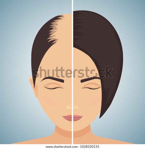 Front view portrait of a woman with\
alopecia before and after hair treatment and transplantation.\
Divided image of the head. Two halves. Health care and beauty\
concept. Vector\
illustration.