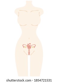 Frontal illustration of female body and uterine fibroids
