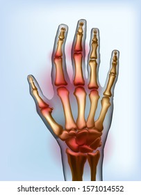 Frontal view image sore osteoarthritis joints of bones the of hand.