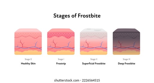 Frostbite anatomical infographic poster. Vector flat medical illustration. Stages of hypothermia disease. Skin layer stage of healthy, frostnip, superficial and deep. Design for healthcare dermatology