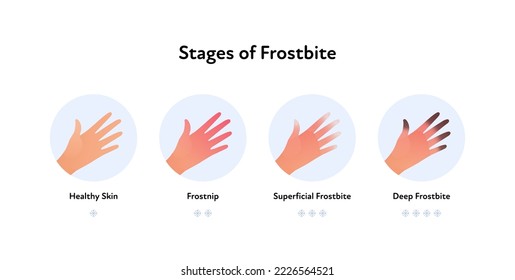 Frostbite anatomical infographic poster. Vector flat medical illustration. Stages of hypotermia. Hand with finger stage of healthy, frostnip, superficial and deep. Design for healthcare dermatology