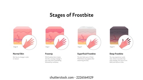 Frostbite anatomical infographic. Vector flat healthcare illustration. Stages of hypothermia. Skin layers and hand with finger healthy, frostnip, superficial and deep stage. Design for dermatology