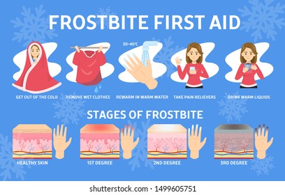 Frostbite first aid infographic. Hypothermia in cold winter season. Fingers damage, stages of frostbite. Vector illustration in cartoon style