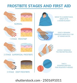 Vector de infografía Frostbite aislado. Primeros auxilios y etapas de hipotermia. Dedos dañados. Tratamiento del área congelada. Concepto de atención médica, síntomas de congelación.