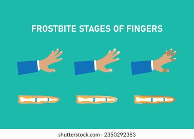 Frostbite stages of fingers 2d vector illustration concept for banner, website, landing page, flyer, etc