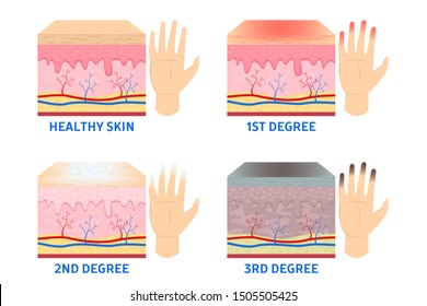 Frostbite Hd Stock Images Shutterstock