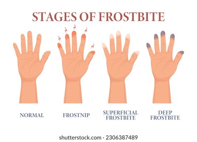 Frostbite stages. Frozen hands in different stages. Medical frostbite. Skin burn symptom. Health care medical concept. Vector	
