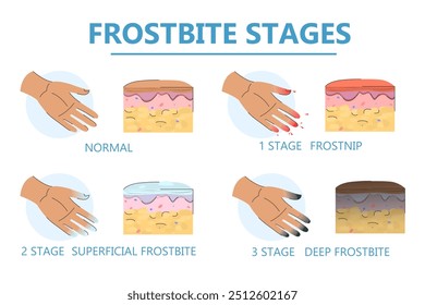 Vector de infografía de etapas de congelación aislado. Dedos dañados. Signos de hipotermia. Concepto de atención médica, síntomas de congelación.