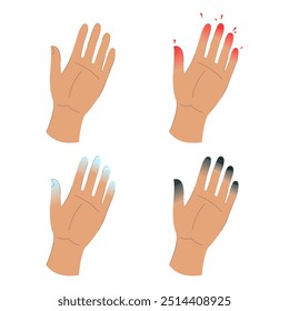 Vector de infografía de etapas de congelación aislado. Dedos dañados. Signos de hipotermia. Concepto de atención médica, síntomas de congelación.