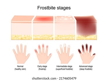 Frostbite Stages. The Symptoms In Progress. Comparison Of Skin Injury After Freezing. Humans Fingers On A Palm After Early Stage Or Frostnip, Intermediate Stage Or Superficial Frostbite And Deep