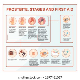 Frostbite - symptoms, protection and treatment. infographics illustration in vector. First aid while hypothermia.