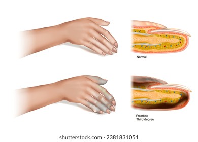 Frostbite Third degree. Skin injury that occurs when exposed to extreme low temperatures, causing the freezing of the skin or other tissues. 