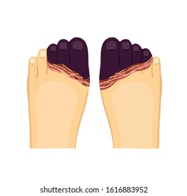 Frostbite toes and feet vector illustration on white background.