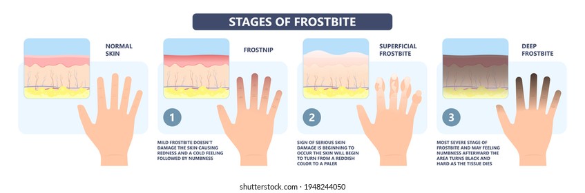 Frostbite Treat Toes Cold Ice Improperly Icing Injury Burn Skin Tissue White Yellow Black Frozen Pain Numbness Tingling Snow Blistered Loss Muscle Freeze First Aid Raynaud Deep Prevent