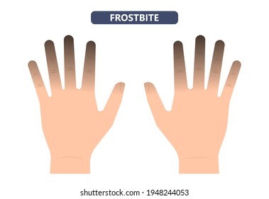 Frostbite Treat Toes Cold Ice Improperly Icing Injury Burn Skin Tissue White Yellow Black Frozen Pain Numbness Tingling Snow Blistered Loss Muscle Freeze First Aid Raynaud Deep Prevent