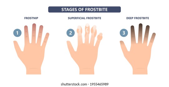 Frostbite Treat Toes Cold Ice Improperly Icing Injury Burn Skin Tissue White Yellow Black Frozen Pain Numbness Tingling Snow Blistered Loss Muscle Freeze First Aid Raynaud Deep Prevent