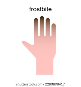 Frozen hand with fingers vector illustration. Medical frostbite. Skin burn symptom.