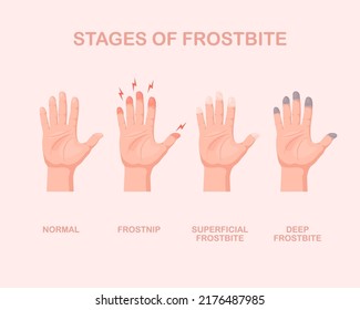 Frozen hands with fingers. Stage of frostbite. Skin burn symptom. Vector illustration isolated.