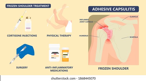 Frozen Shoulder Adhesive Capsulitis Surgery Stiff Crush Ribs Bone Lift Athletes Arm Rupture Symptom Freezing Stiffness Rheumatoid Arthritis Swelling Of