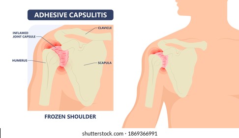 Frozen Shoulder Adhesive Capsulitis Surgery Stiff Crush Ribs Bone Lift Athletes Arm Rupture Symptom Freezing Stiffness Rheumatoid Arthritis Swelling Of