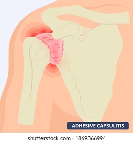 Anatomía del síndrome de Capsulitis Adhesiva inflamación del hombro