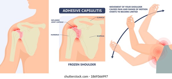 Frozen shoulder adhesive capsulitis surgery stiff crush ribs bone lift athletes arm rupture symptom freezing stiffness rheumatoid arthritis swelling of