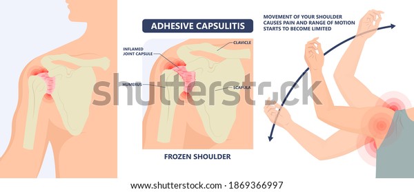 Frozen shoulder adhesive capsulitis\
surgery stiff crush ribs bone lift athletes arm rupture symptom\
freezing stiffness rheumatoid arthritis swelling\
of