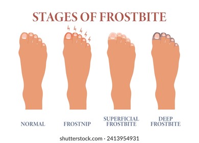 Pies congelados. Etapas de la congelación de dedos. Salud y medicina. Vector