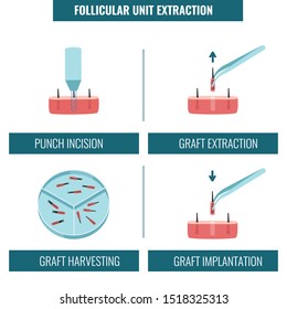 FUE hair transplantation alopecia treatment in 4 steps infographics. Stages set of follicular unit extraction restoration surgery. Medical concept. Flat vector illustration.