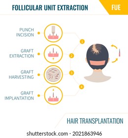 FUE hair transplantation infographics. Female alopecia treatment method. Follicular unit extraction surgery steps. Woman with balding head in rear view. Medical vector illustration.