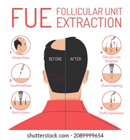 FUE hair transplantation process vector isolated. Follicular unit extraction procedure. Baldness problem, surgical treatment. Graft implantation, medical infographic.