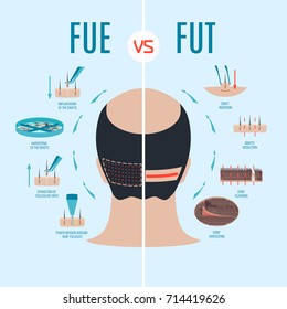 FUE vs FUT. Extracción de unidad folicular frente a trasplante de unidad folicular. Tipos de procedimientos de trasplante capilar y sus etapas. Tratamiento de alopecia masculina. Infografías médicas. Ilustración vectorial.