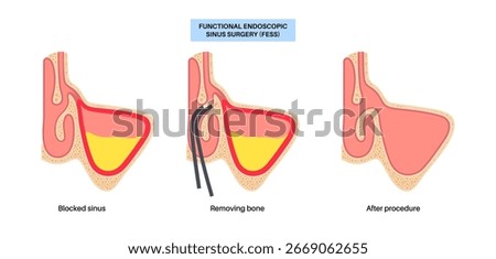 Functional Endoscopic Sinus Surgery. FESS is a minimally invasive ENT procedure. Chronic sinusitis, nasal polyps and blockages treatment. Nasal anatomy, sinus cavities, and surgical instruments vector