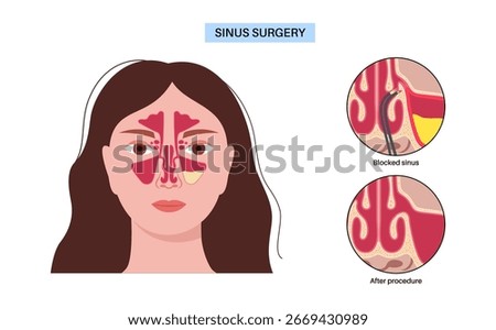 Functional Endoscopic Sinus Surgery. FESS is a minimally invasive ENT procedure. Chronic sinusitis, nasal polyps and blockages treatment. Nasal anatomy, sinus cavities, and surgical instruments vector