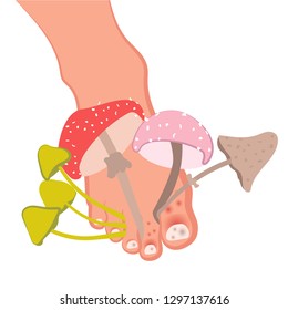 Fungal disease of the skin of the feet and nails. Athlete's foot, onychomycosis, candidiasis. Vector illustration of medical posters and stands