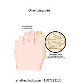 fungal infection of the nail. Onychomycosis. tinea unguium. close-up of A toenail affected by dermatophytic fungus. Trichophyton rubrum