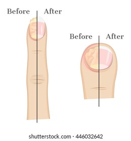 Fungal infection of the nails Illustration Before and After