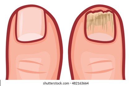 fungal infection of the nails vector illustration