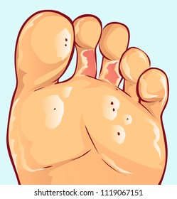 Fungal Infections, vector illustration