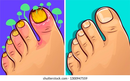 Fungal Infections, vector illustration