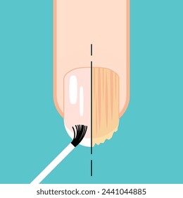 Fungal nail. Nail before and after fungal disease. Fungal and normal nail vector illustration. Nail diseases. Onychomycosis, fungal infection causes, treatment icon