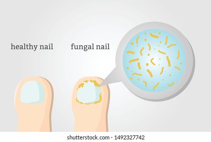 Fungal nail infection and healthy nail disease or beauty problem on the toe vector