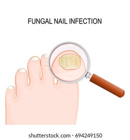 fungal nail infection. Onychomycosis or tinea unguium is a fungal infection of the nail