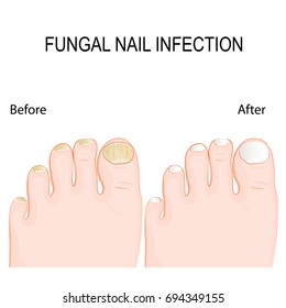 fungal nail infection. Onychomycosis or tinea unguium is a fungal infection of the nail.  Before and after Renewal Treatment. Restore healthy nail appearance.