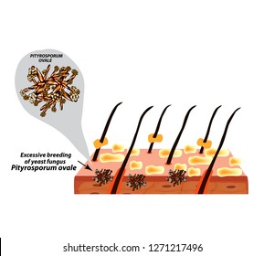 Fungal yeast pathogen seborrhea Pityrosporum ovale Malassezia furfur. Seborrhea skin and hair. Dandruff, seborrheic dermatitis. Anatomical structure. Infographics. Vector illustration.